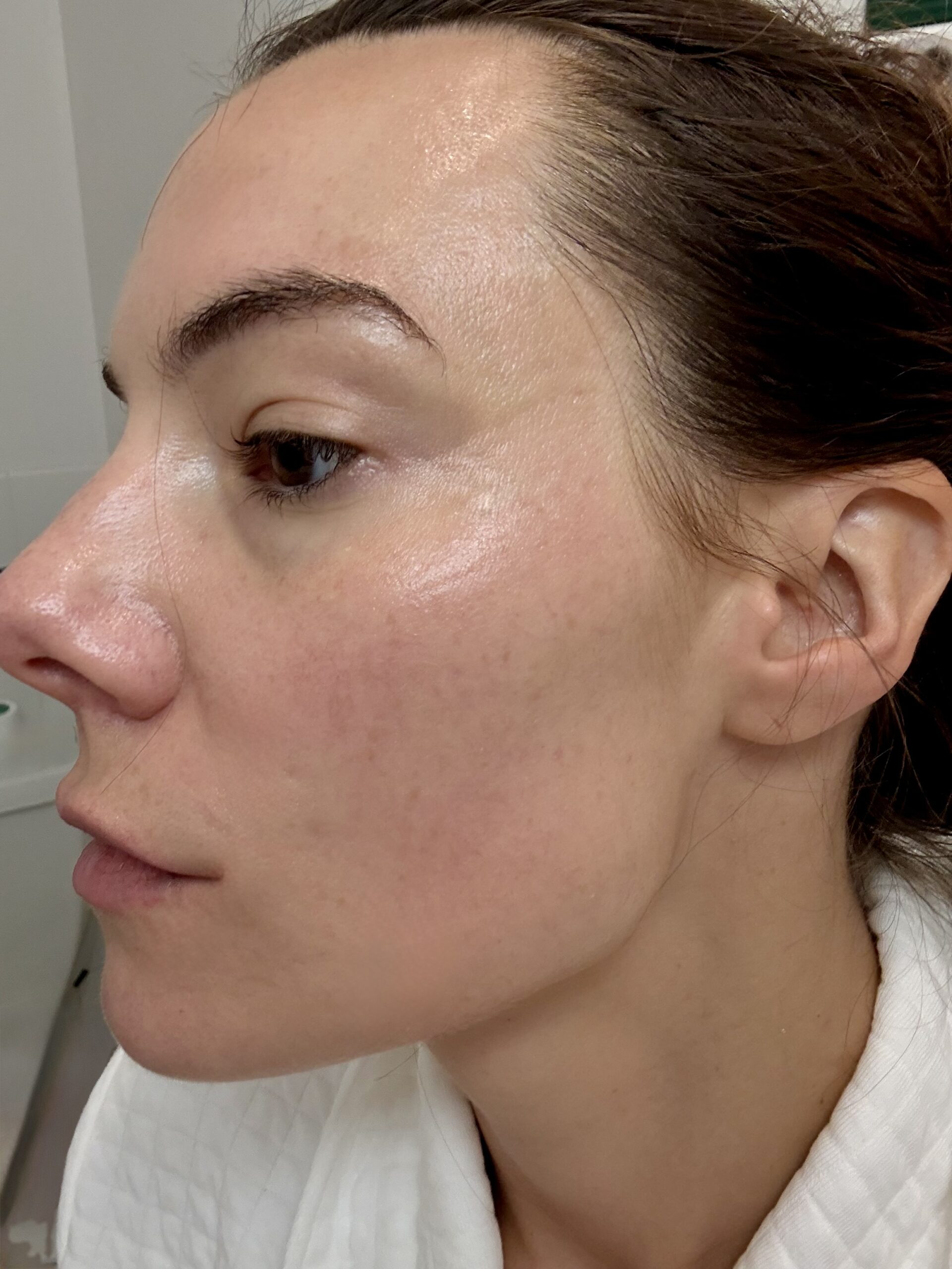 Close up of 35-year-old skin after 1 year of daily use of the CurrentBody red light therapy mask showing maintenance results.